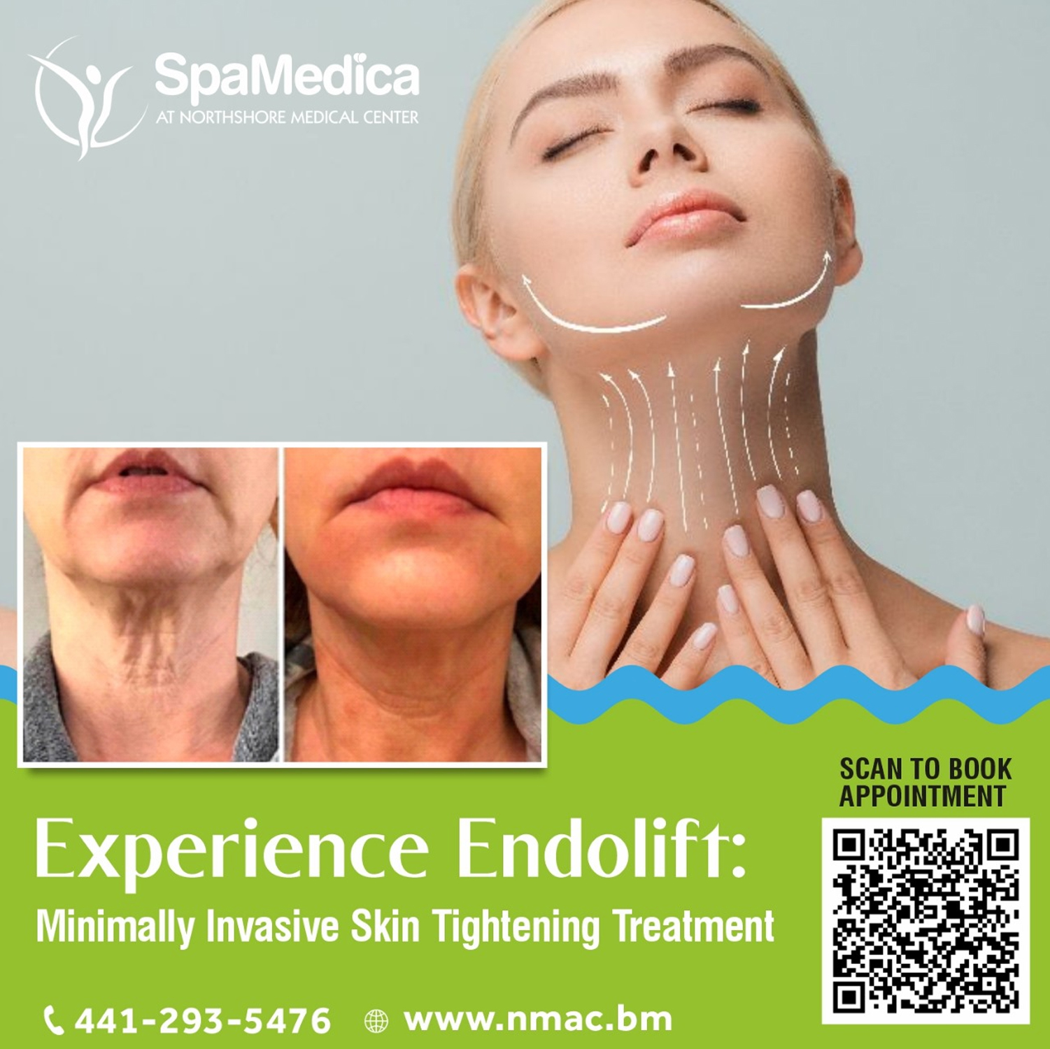 Endolift