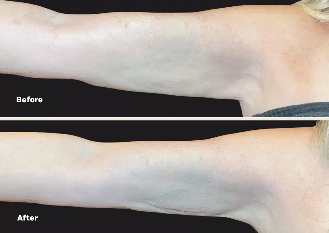 Endolift