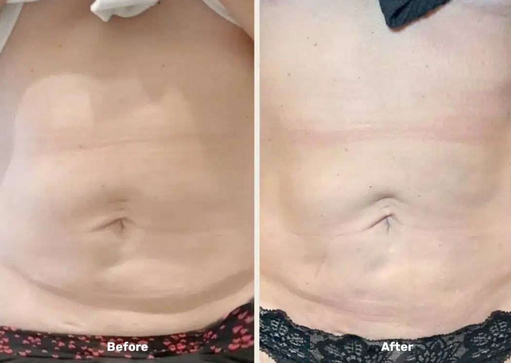 Endolift