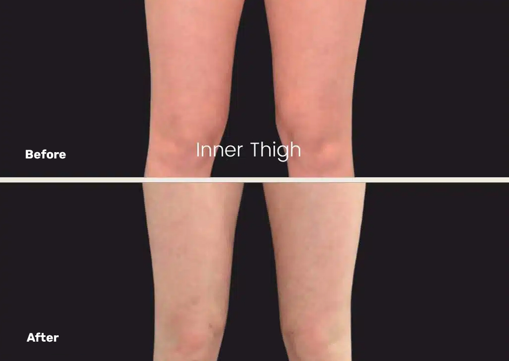 Endolift