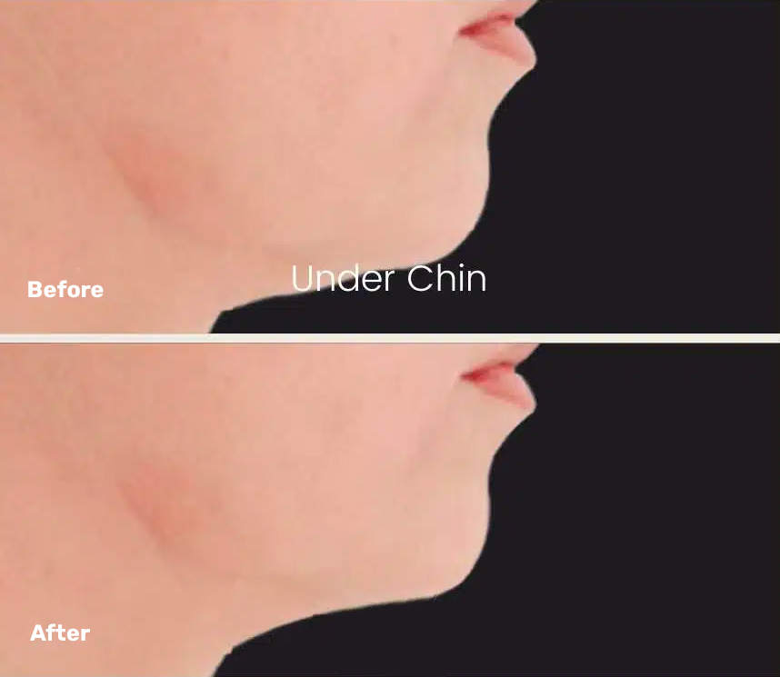Endolift