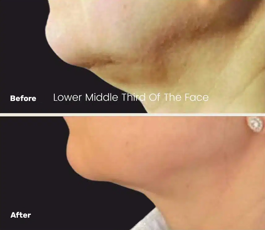 Endolift