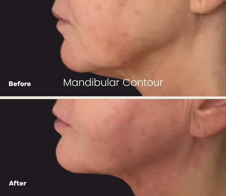 Endolift