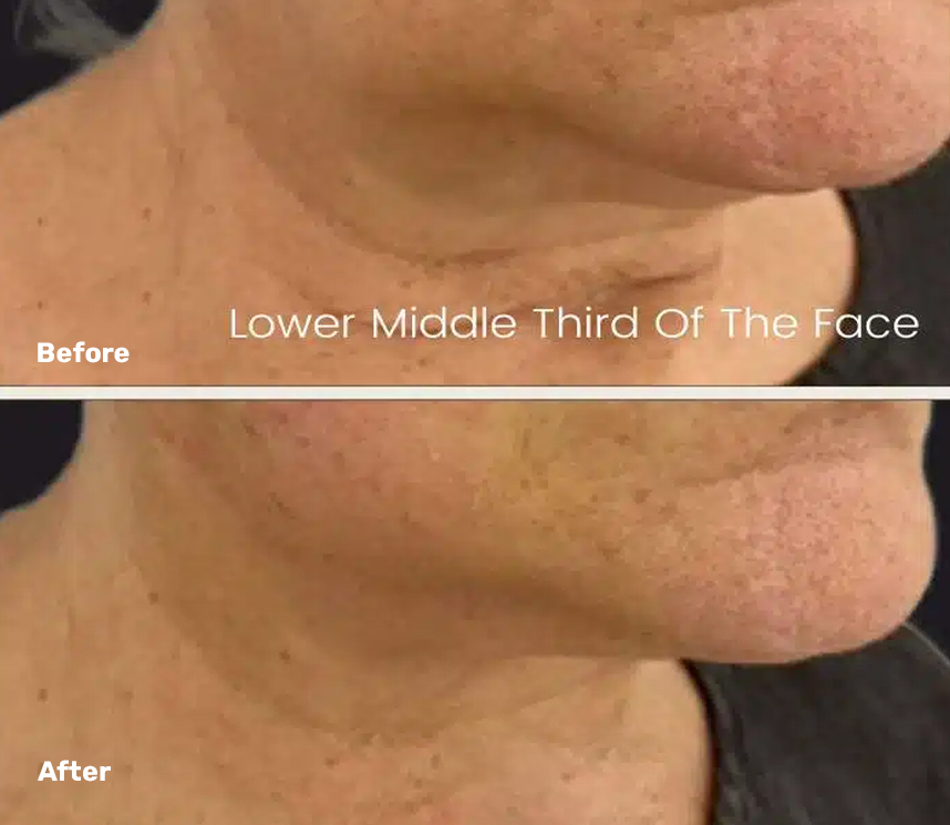 Endolift