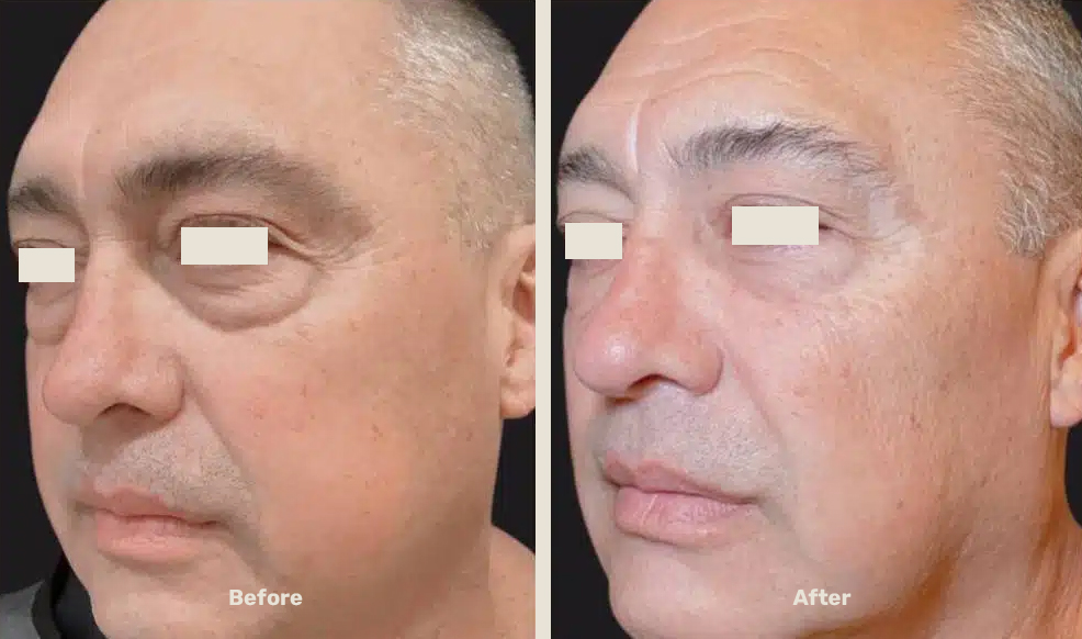 Endolift After Befor