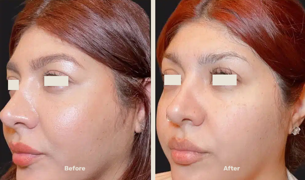 Endolift After Befor