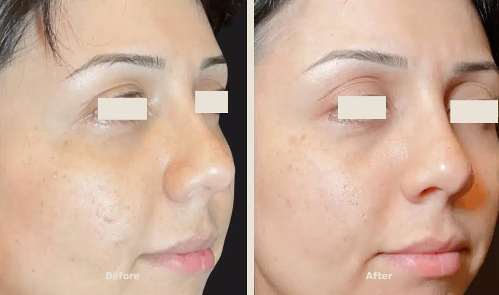 Endolift After Befor