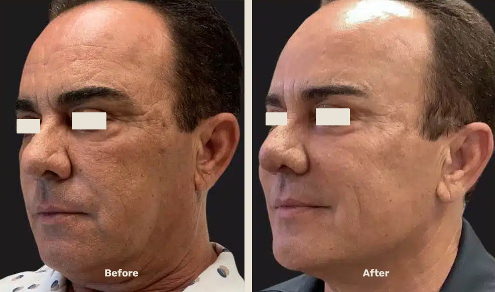 Endolift After Befor