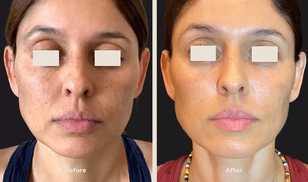 Endolift After Befor