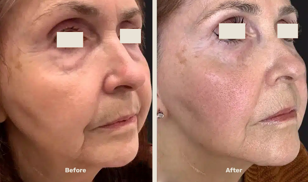 Endolift After Befor