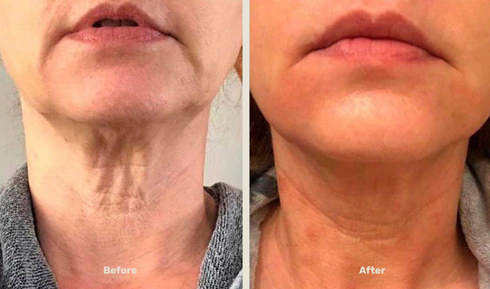 Endolift After Befor