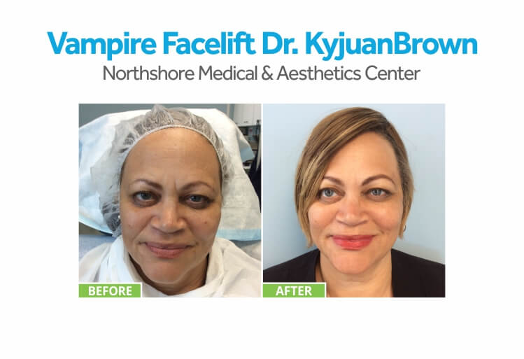 Before & Afters 