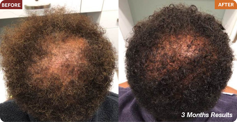 Hair Restoration Treatments