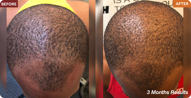 Hair Restoration Treatments