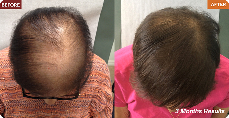 Hair Restoration Treatments