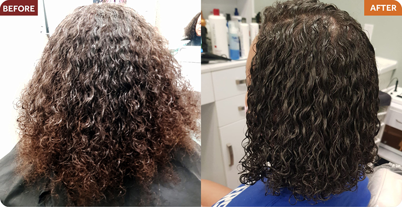 Hair Restoration Treatments