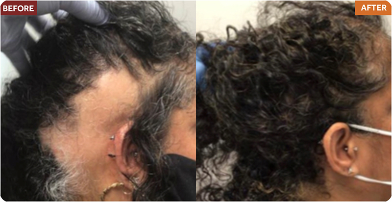 Hair Restoration Treatments