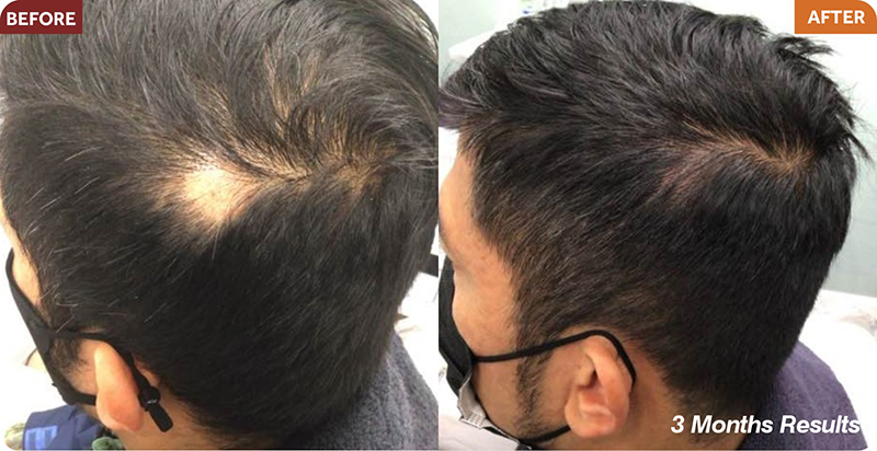 Hair Restoration Treatments