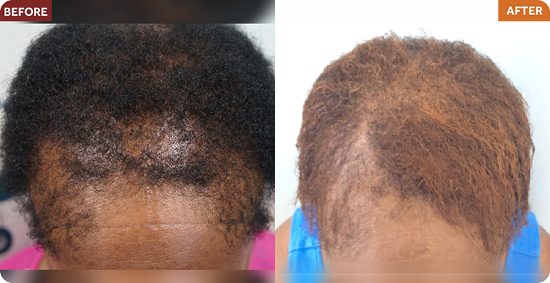 Hair Restoration Treatments