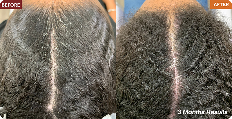Hair Restoration Treatments