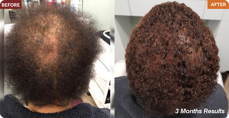 Hair Restoration Treatments