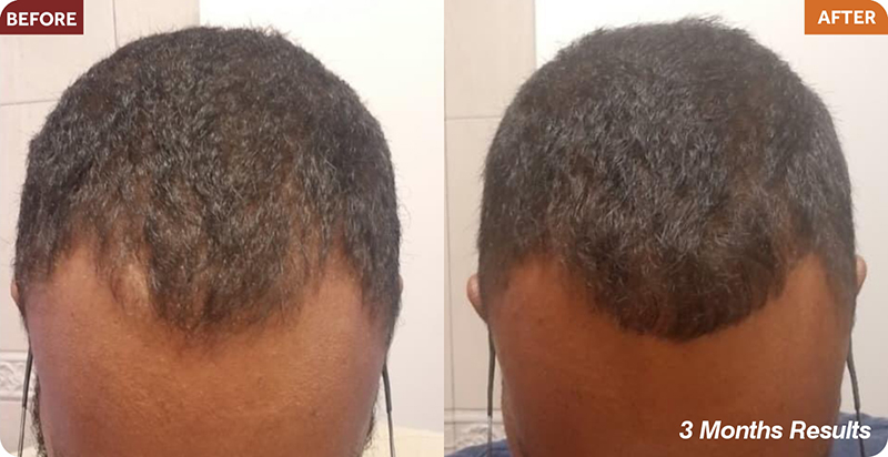 Hair Restoration Treatments
