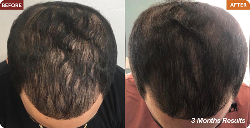 Hair Restoration Treatments