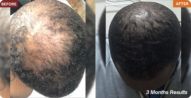 Hair Restoration Treatments