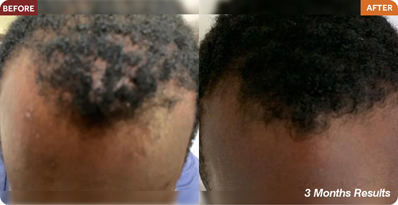 Hair Restoration Treatments