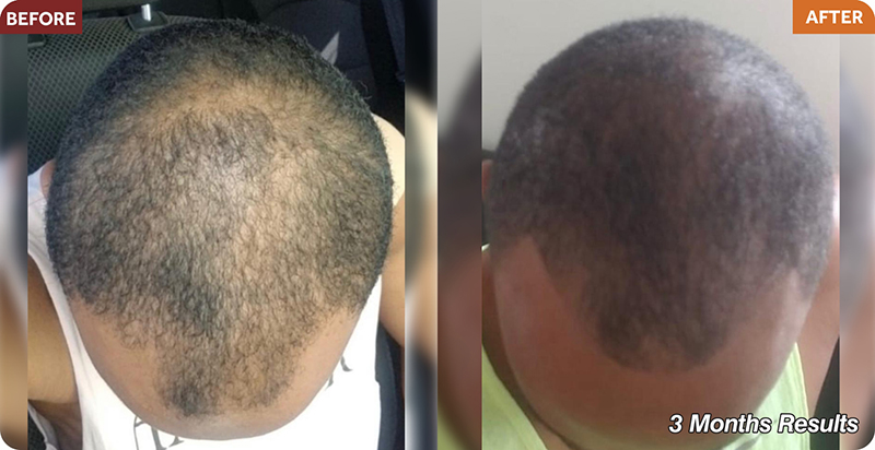 Hair Restoration Treatments
