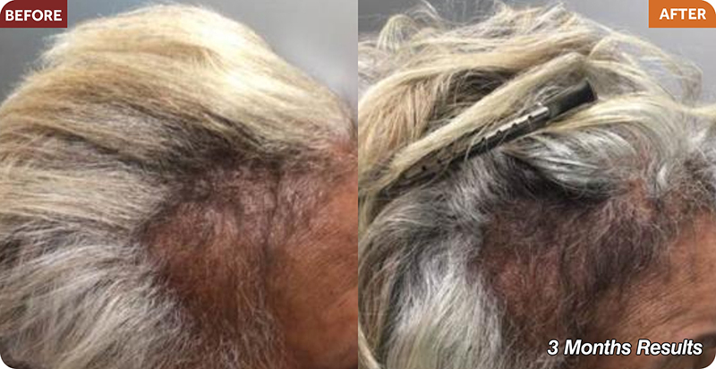 Hair Restoration Treatments