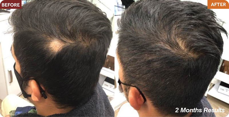 Hair Restoration Treatments