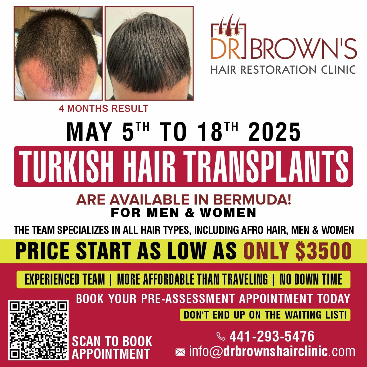 Turkish Hair Transplant
