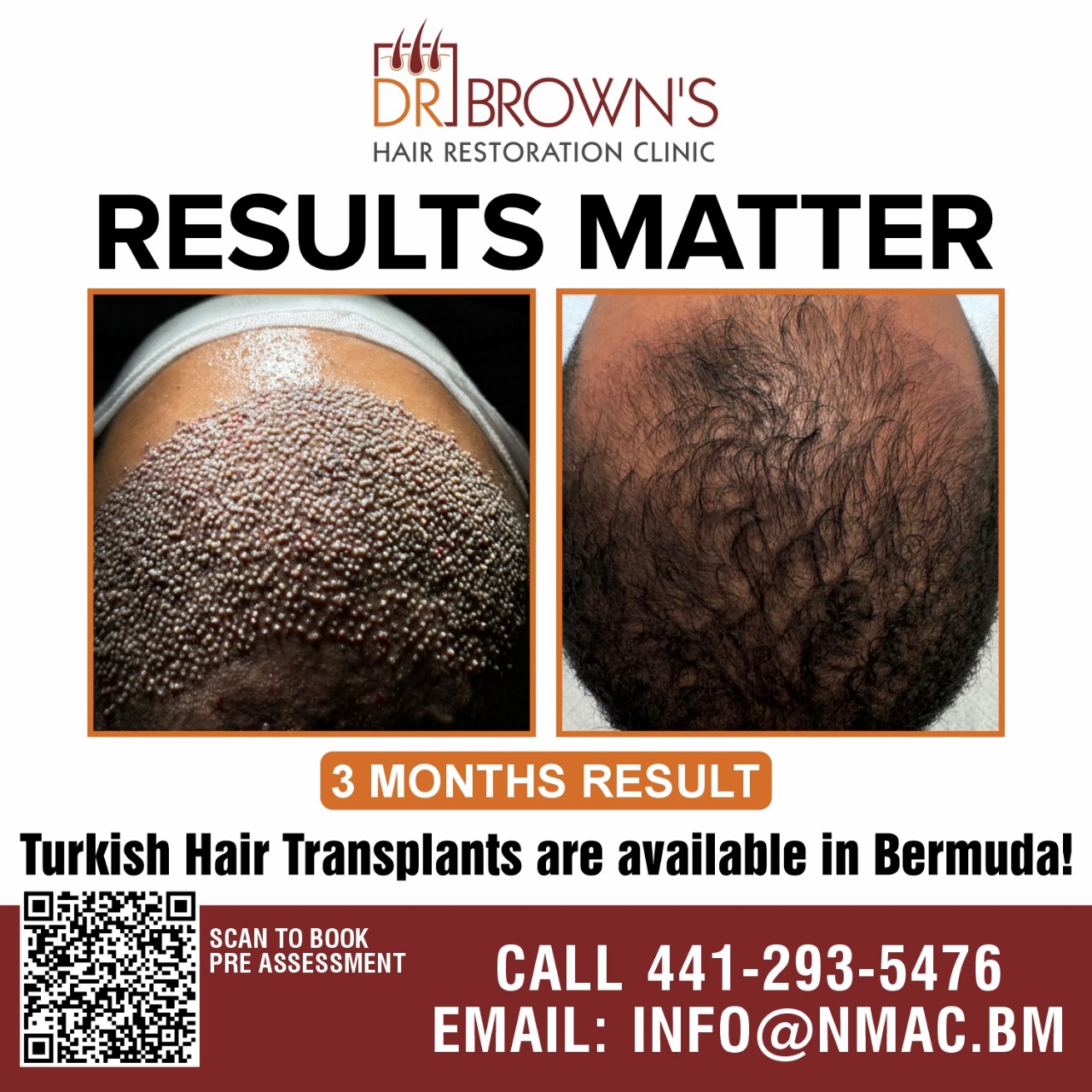 Turkish Hair Transplant