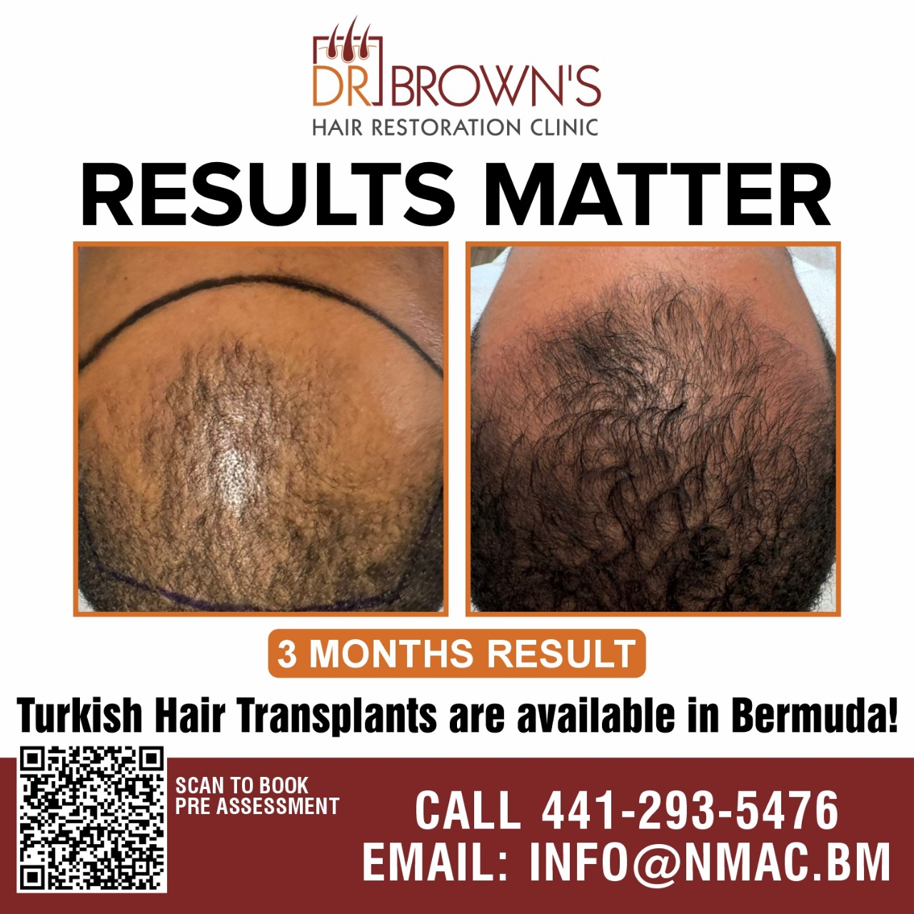 Turkish Hair Transplant