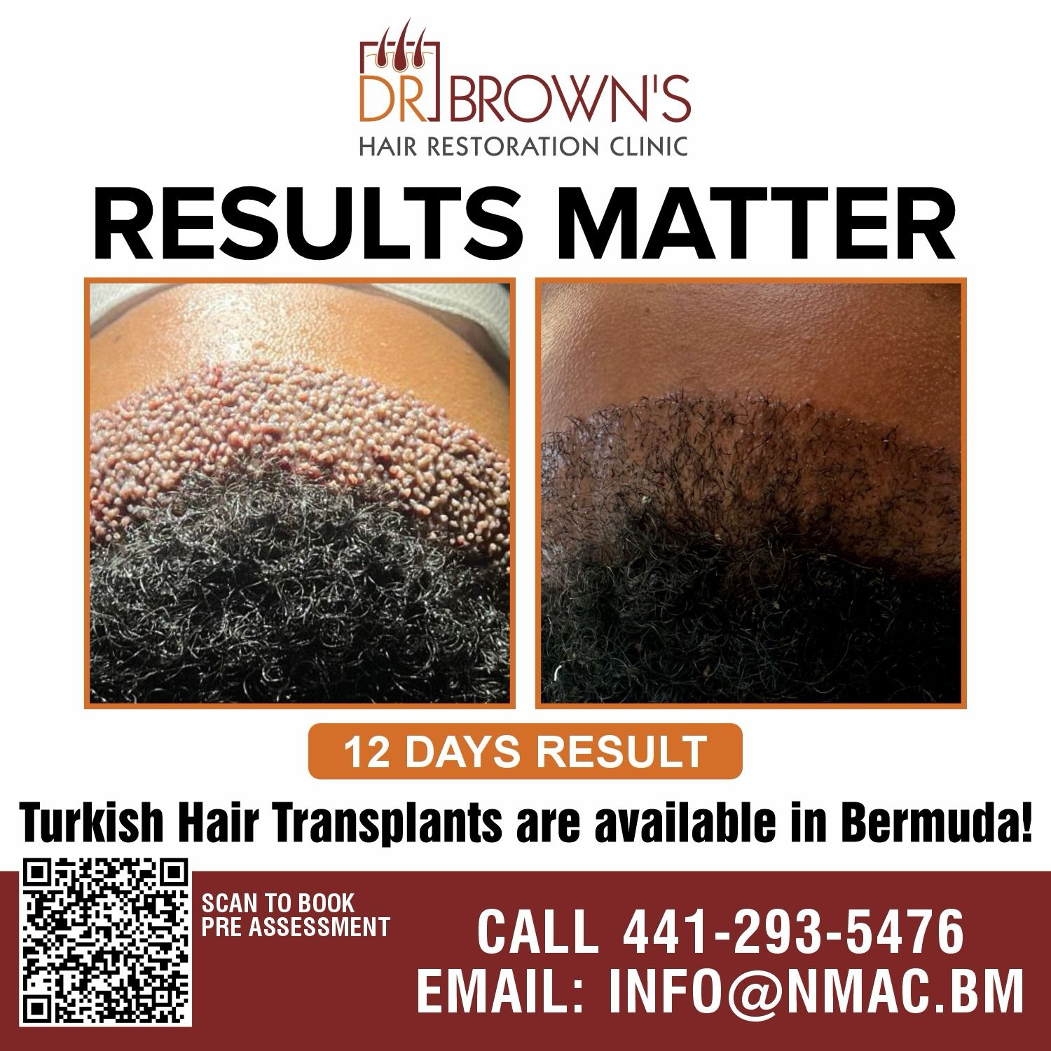 Turkish Hair Transplant