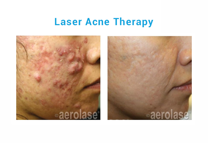 Laser acne therapy