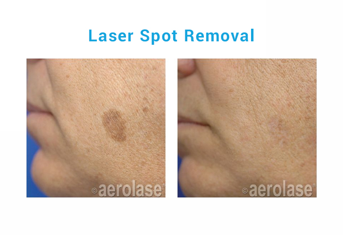 Laser spot removal