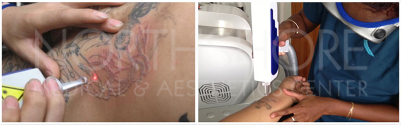 Laser Tattoo Removal