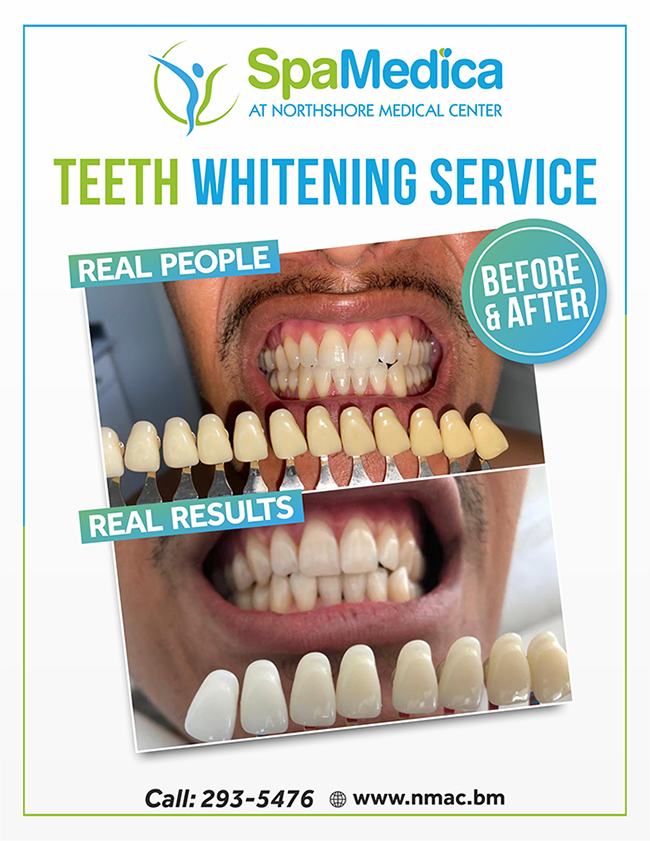 Teeth Whitening
