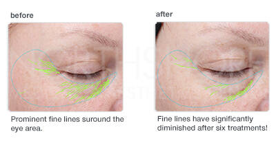 Bioactive Peel After Before