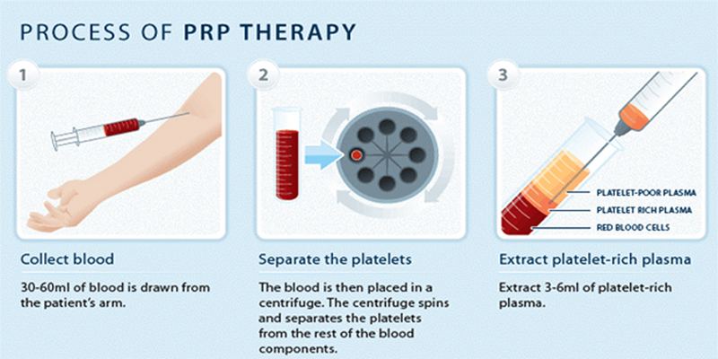 Platelet plasa