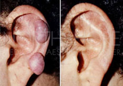 Scar & keloid Treatments