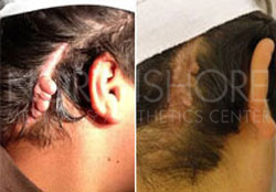 Scar & keloid Treatments