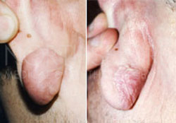 Scar & keloid Treatments