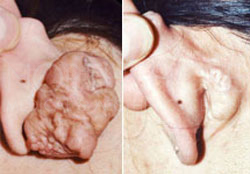 Scar & keloid Treatments
