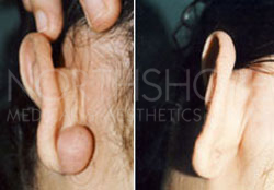 Scar & keloid Treatments