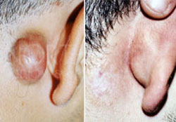 Scar & keloid Treatments