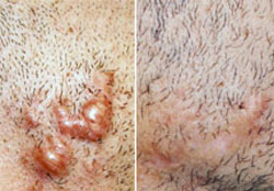 Scar & keloid Treatments