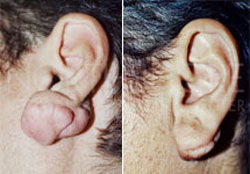 Scar & keloid Treatments
